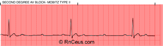 Disease And Treatment Second Degree AV Block mobitz II 