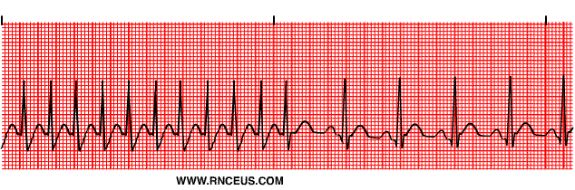 Tachycardia Paroxysmal